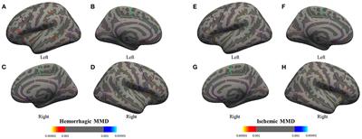 Moyamoya Disease With Initial Ischemic or Hemorrhagic Attack Shows Different Brain Structural and Functional Features: A Pilot Study